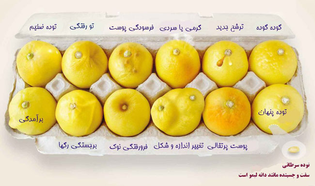 سرطان پستان