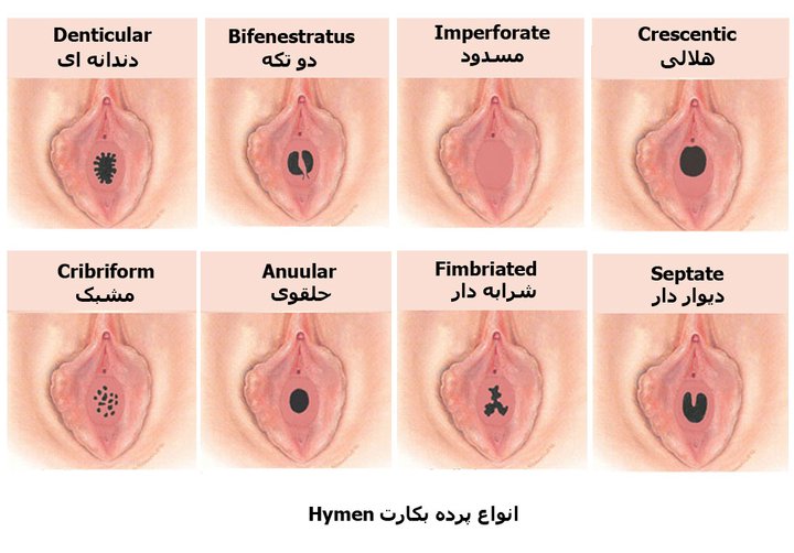انواع پرده بکارت