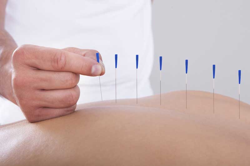طب سوزنی برای درمان اختلال نعوظ